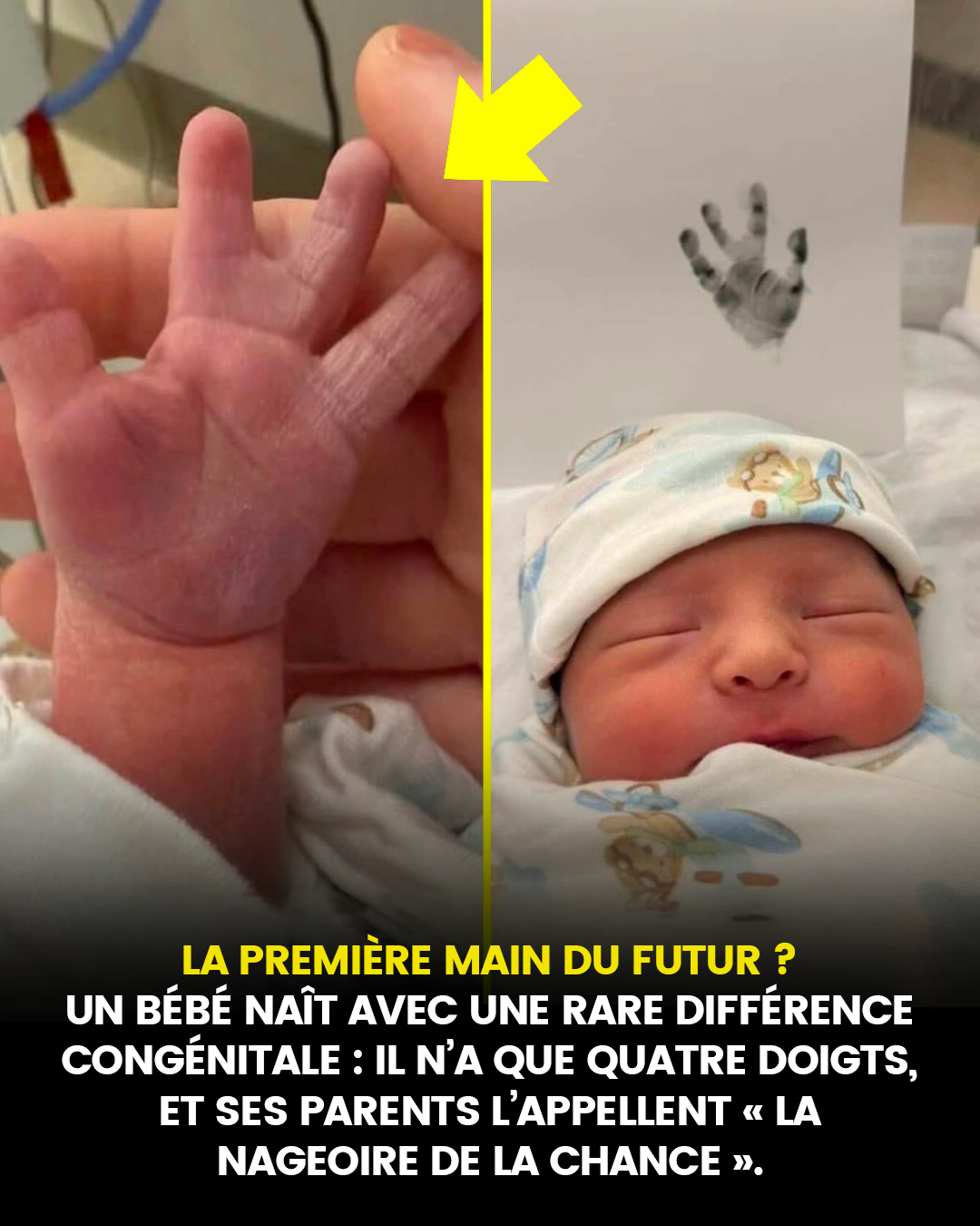 La première main du futur ? Un bébé naît avec une rare différence congénitale : il n’a que quatre doigts, et ses parents surnomment sa main « la nageoire de la chance ».