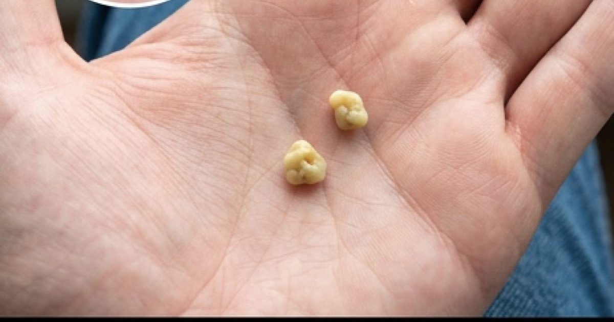 Les calculs biliaires : que sont-ils et comment s’en débarrasser ?