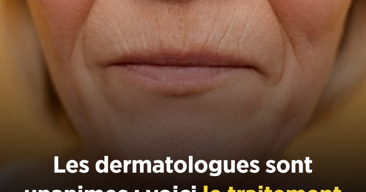Les dermatologues sont unanimes : voici le traitement le plus efficace pour atténuer les rides autour de la bouche