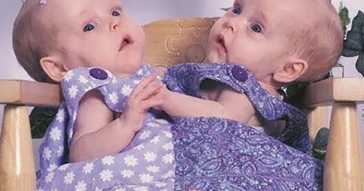 Les jumelles siamoises Belle et Abby étaient physiquement reliées depuis leur naissance