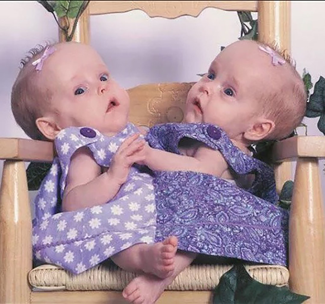 Les jumelles siamoises Belle et Abby étaient physiquement reliées depuis leur naissance