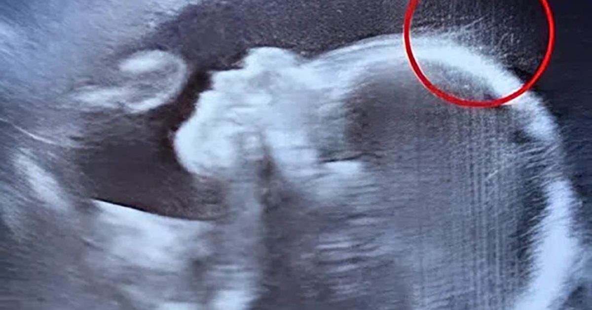 Les médecins n’en croyaient pas leurs yeux lors de l’échographie. Mais à sa naissance, le charme, la force et l’histoire de ce bébé ont touché les cœurs du monde entier d’une manière totalement inattendue