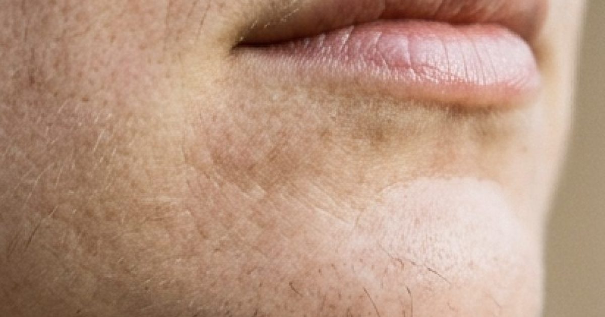 Les poils au menton d'une femme sont un signe de...