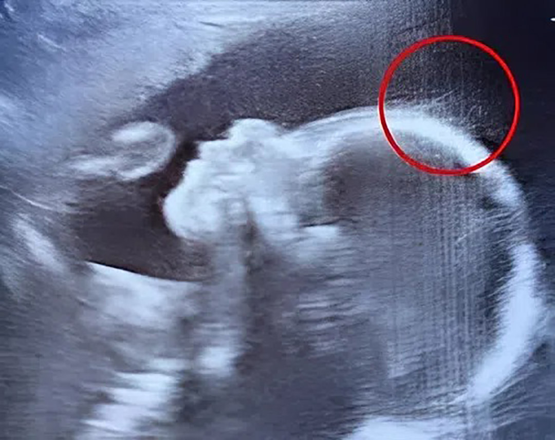 Lors de l’échographie, les médecins ont été stupéfaits. À sa naissance, cette petite fille a bouleversé le monde par sa résilience et sa grâce