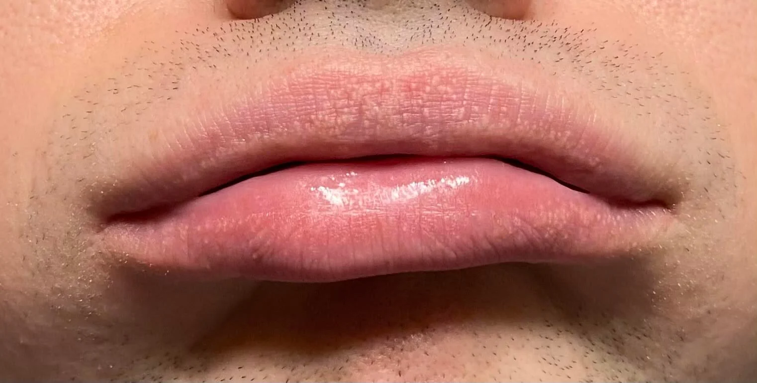 Petits points blancs sur la peau : le vrai visage des glandes de Fordyce