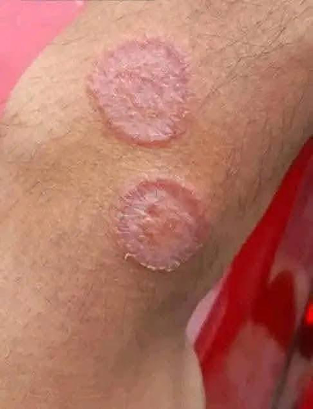 L’urticaire, un signal d’alerte à ne pas ignorer