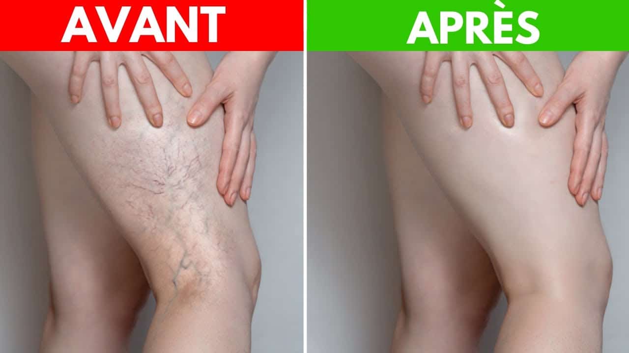 Comparaison avant/après traitement naturel