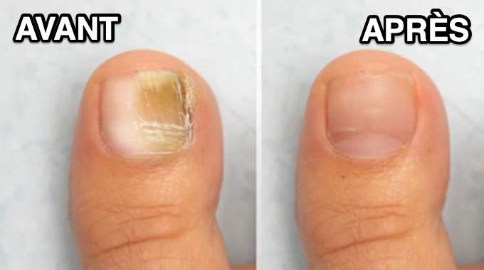 Le laurier, votre nouvel allié cuisine pour des ongles en pleine santé