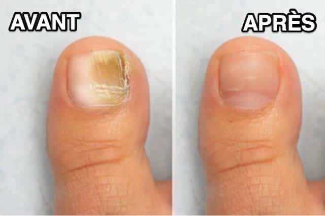Ongles atteints de mycose