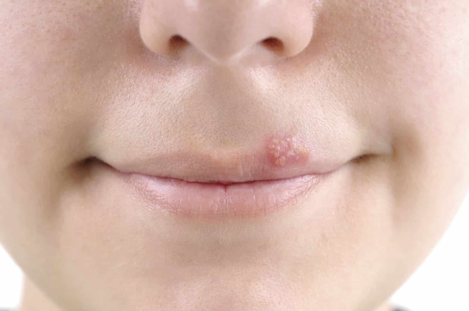 Prévention des boutons de fièvre