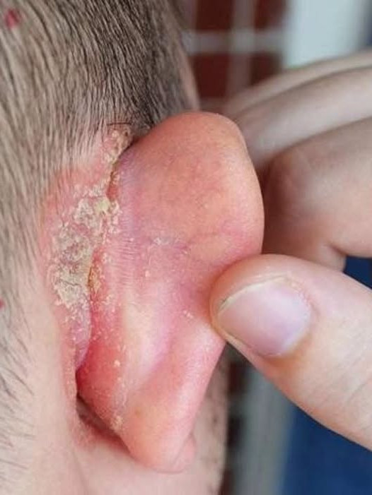 Tache sur l'oreille de mon enfant : que faire en attendant la consultation ?
