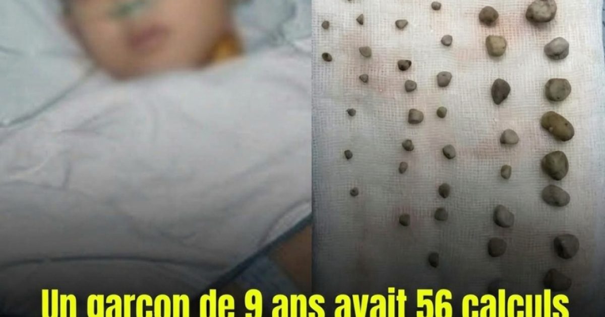 Calculs urinaires chez l'enfant : ce que chaque parent devrait absolument savoir