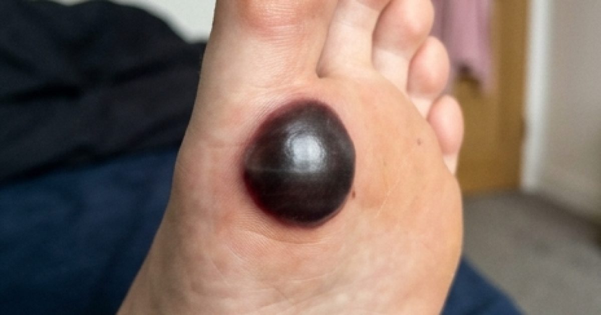 Ma fille s'est réveillée avec une grosse tache sur le pied : que faire et quand s'inquiéter ?