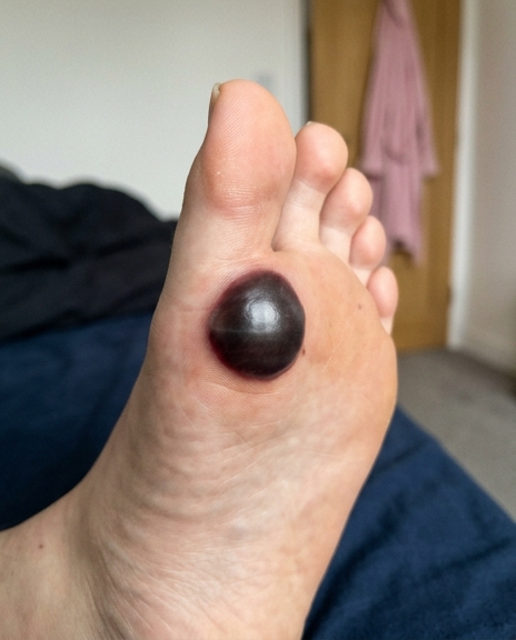 Ma fille s'est réveillée avec une grosse tache sur le pied : que faire et quand s'inquiéter ?