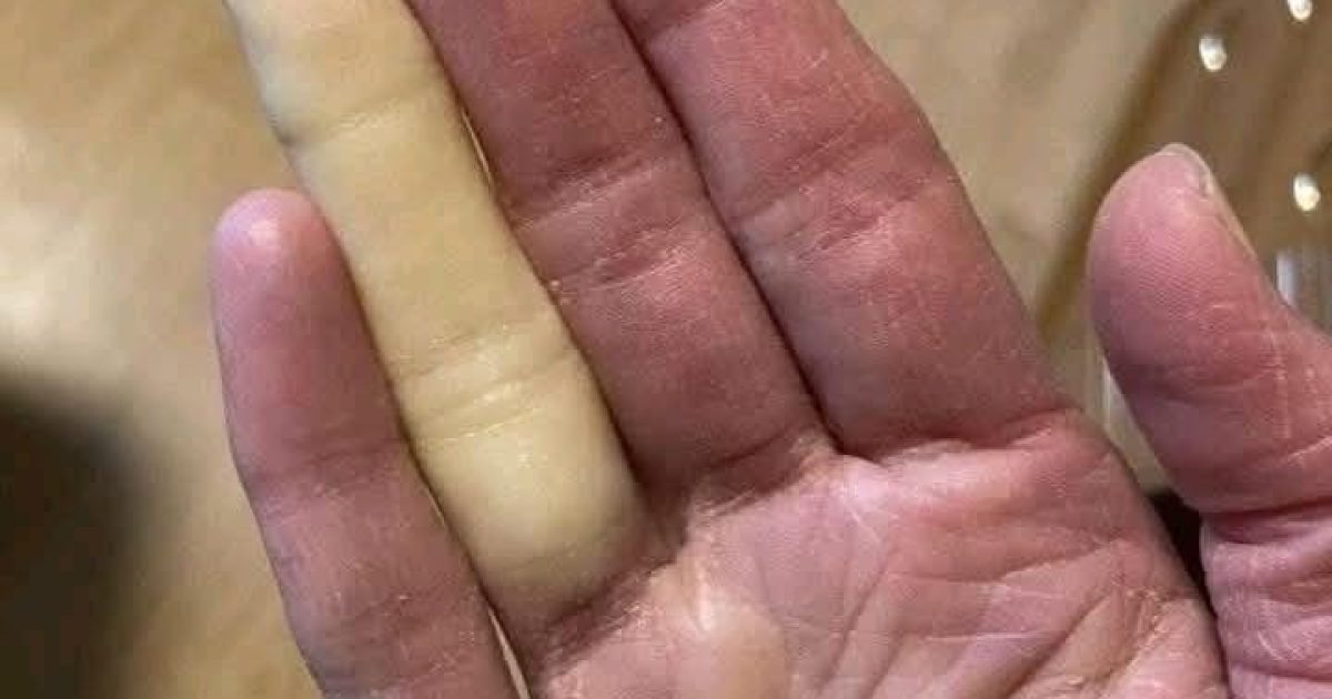 Doigts qui blanchissent dans le froid : ce que votre corps cherche à vous dire
