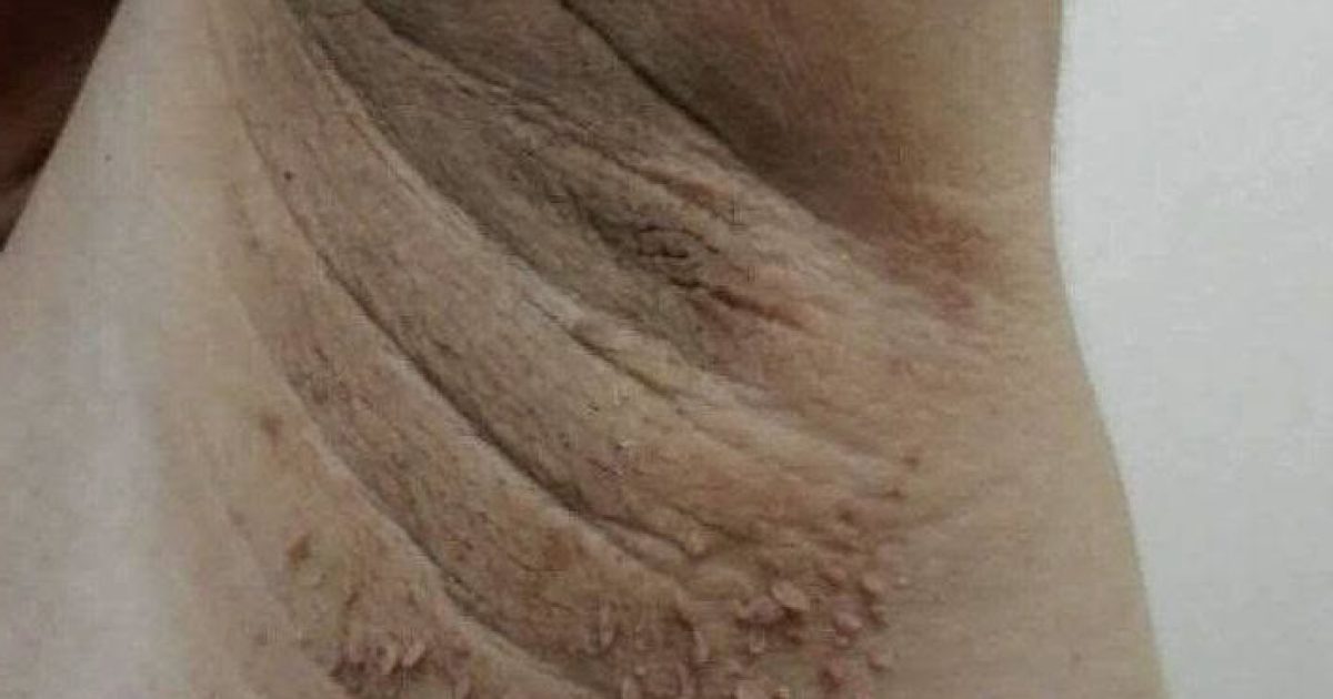 Ces taches foncées sur la peau que l'on prend pour de la saleté : ce qu'elles signifient vraiment