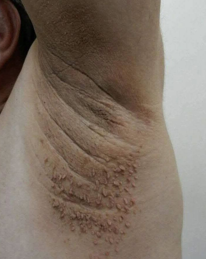 Ces taches foncées sur la peau que l'on prend pour de la saleté : ce qu'elles signifient vraiment