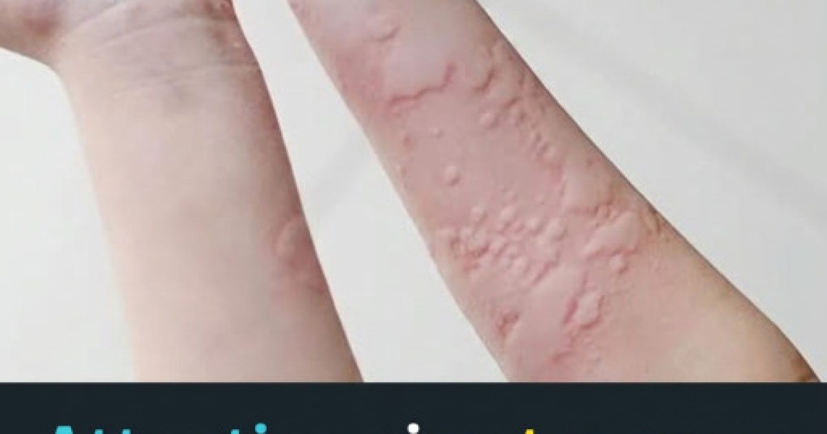 Urticaire : les causes surprenantes qui se cachent derrière ces plaques rouges qui grattent