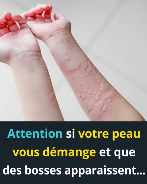 Urticaire : les causes surprenantes qui se cachent derrière ces plaques rouges qui grattent