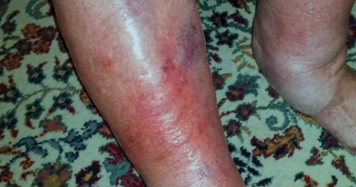 Cette tache rouge sur la peau que vous ne devriez jamais ignorer : les dermatologues tirent la sonnette d'alarme
