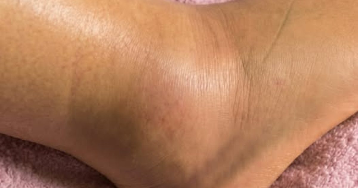 Jambes gonflées : 6 causes surprenantes que votre corps essaie de vous signaler