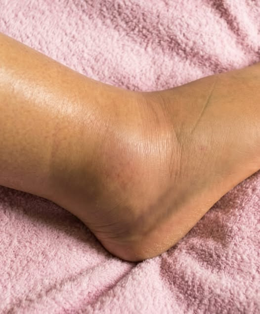 Jambes gonflées : 6 causes surprenantes que votre corps essaie de vous signaler