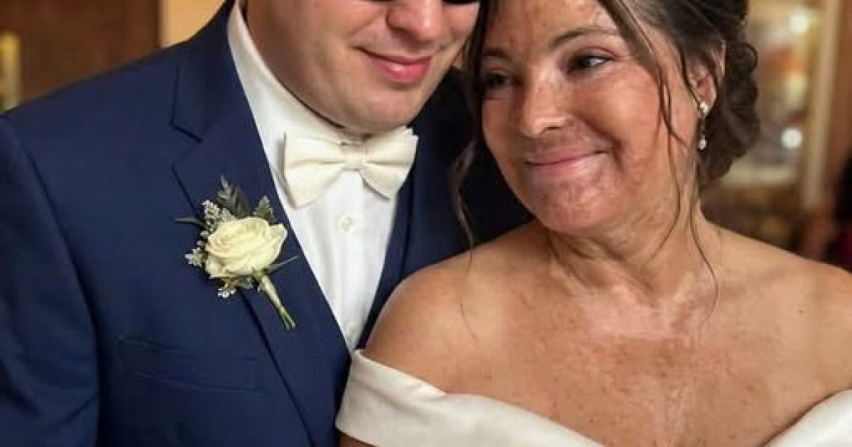 Elle a épousé un homme aveugle pour cacher ses cicatrices : le secret qu'il lui a révélé le soir de leurs noces a tout bouleversé