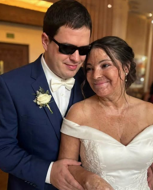 Elle a épousé un homme aveugle pour cacher ses cicatrices : le secret qu'il lui a révélé le soir de leurs noces a tout bouleversé
