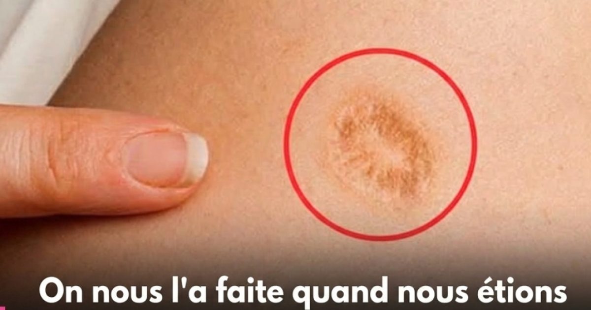Cette cicatrice ronde sur le bras que beaucoup de gens ont sans vraiment savoir ce qu'elle signifie