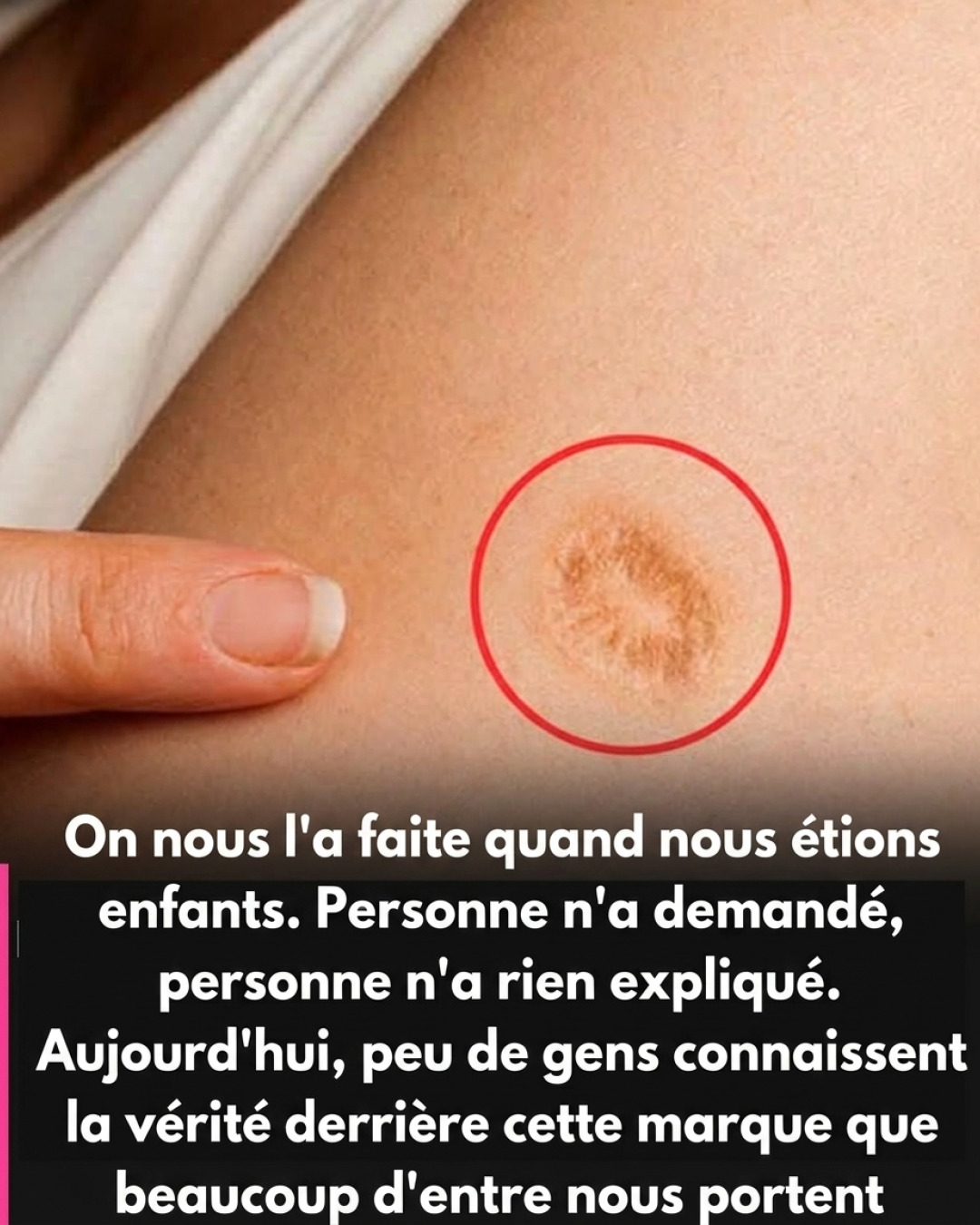 Cette cicatrice ronde sur le bras que beaucoup de gens ont sans vraiment savoir ce qu'elle signifie