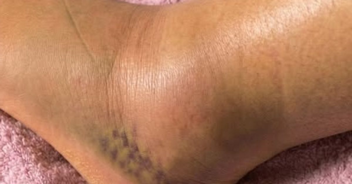 Jambes gonflées : 6 causes courantes que votre corps essaie de vous signaler