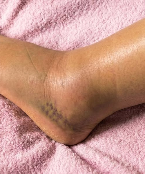 Jambes gonflées : 6 causes courantes que votre corps essaie de vous signaler