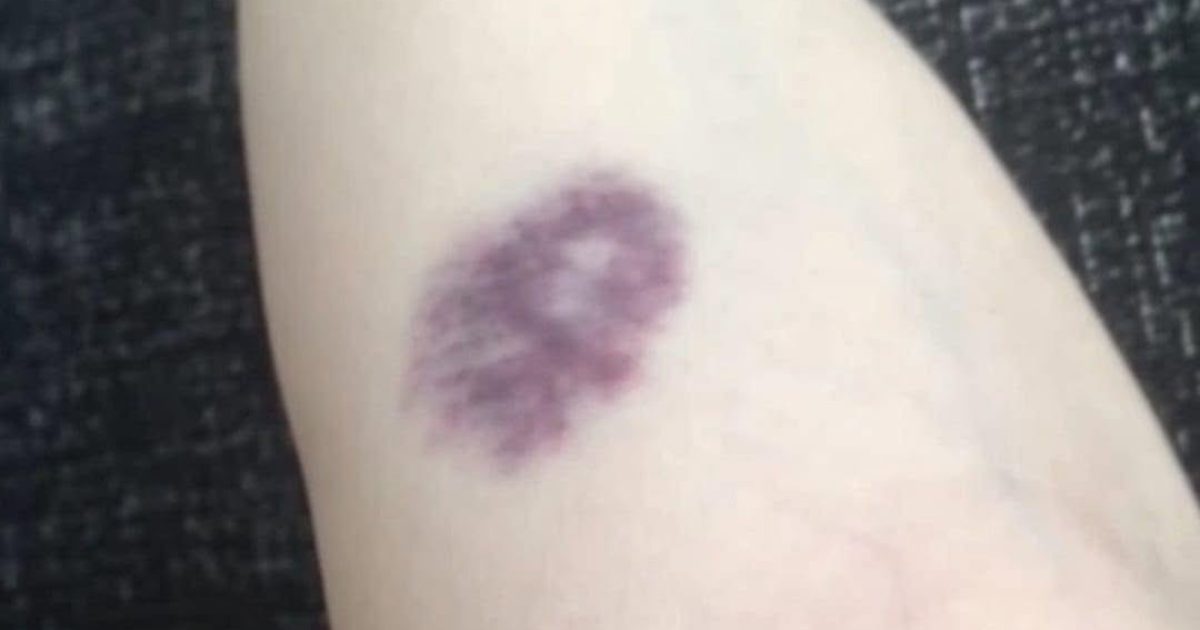 Ces bleus inexpliqués sur votre corps : quand votre peau envoie un signal d'alarme