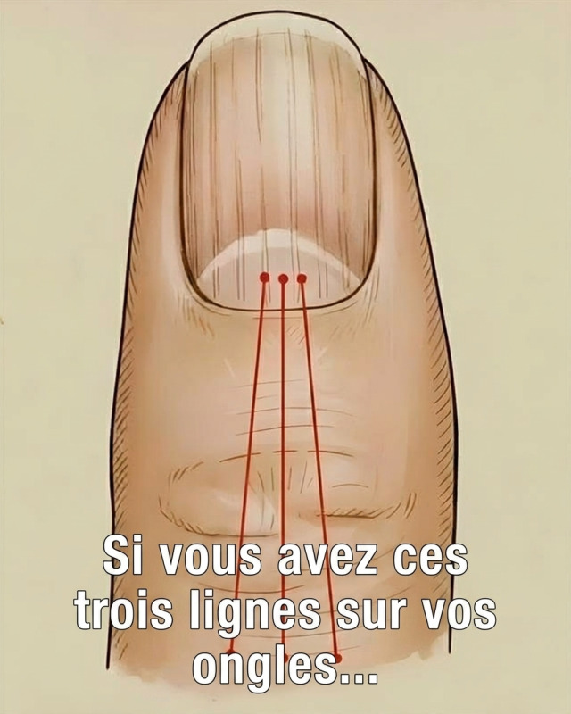 Stries sur les ongles : ce que vos mains essaient de vous dire sur votre santé