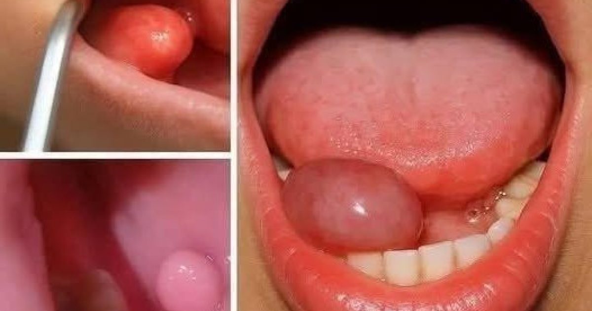 Petite bosse dans la bouche : les premiers signes à ne surtout pas ignorer