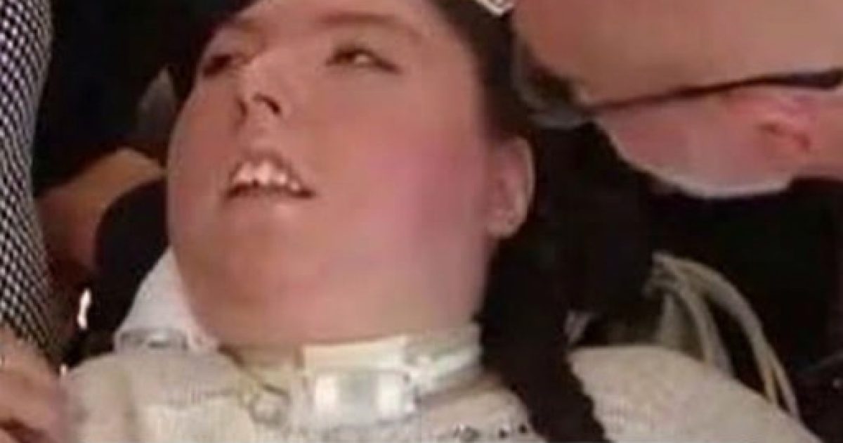 Née sans cerveau, Alex fête ses 20 ans : l'incroyable histoire d'une jeune femme qui a défié tous les pronostics
