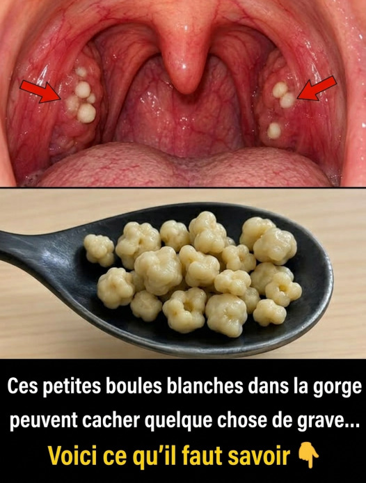 Ces petites boules blanches dans la gorge : ce que sont les calculs amygdaliens et comment s'en débarrasser
