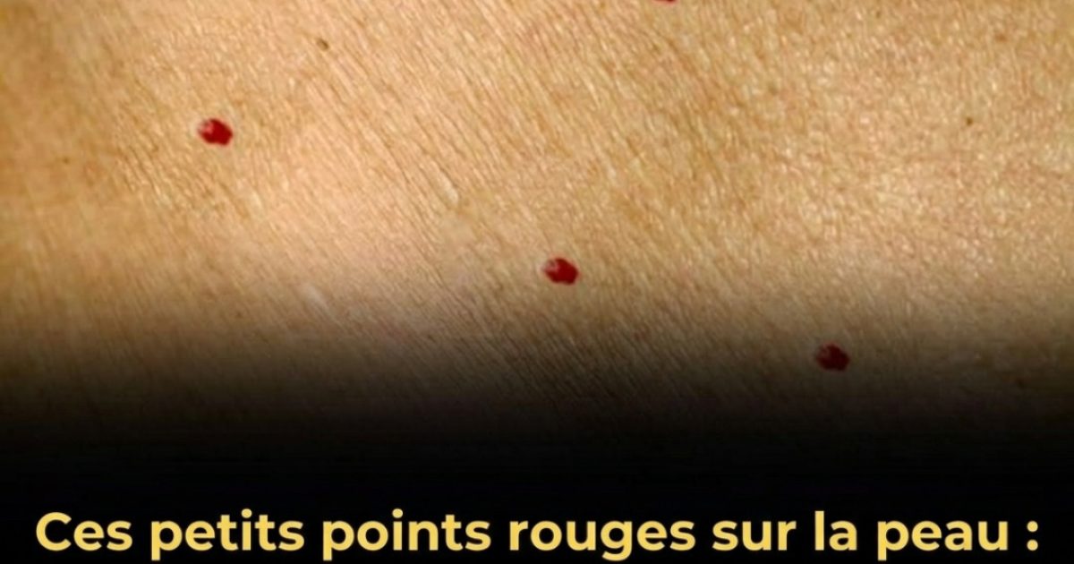 Ces points rouges sur la peau : ce qu'ils révèlent vraiment sur votre santé