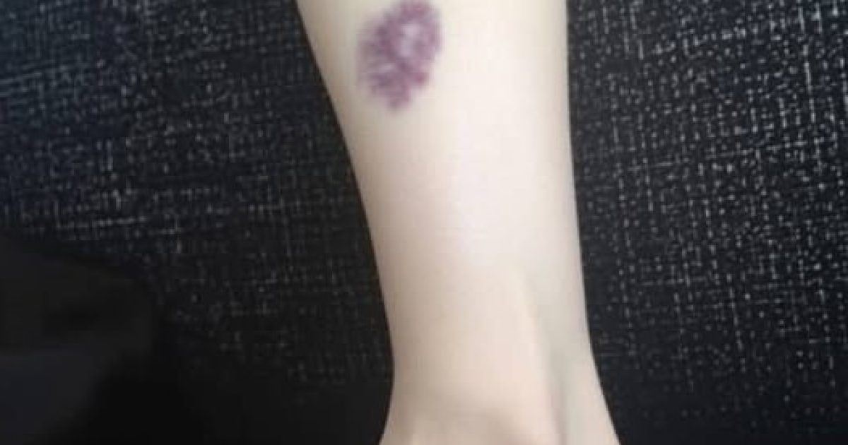 Ces bleus sur la peau qui apparaissent sans raison : quand faut-il vraiment s'inquiéter ?