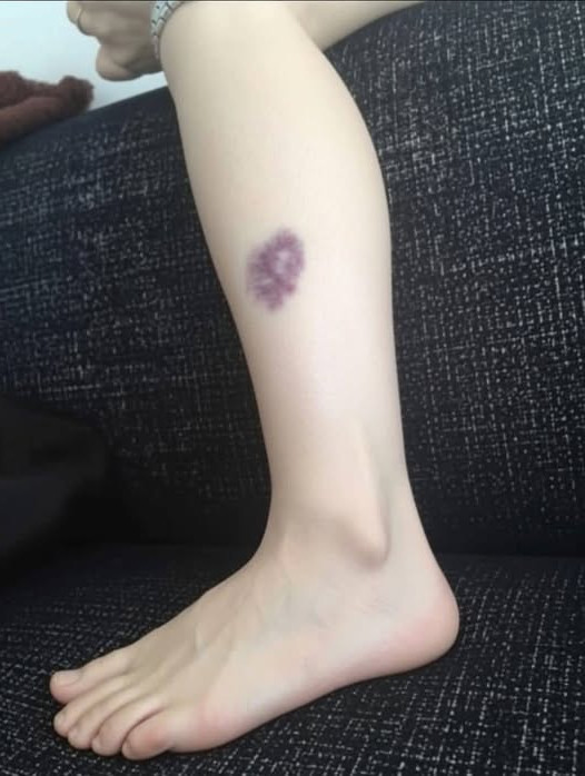Ces bleus sur la peau qui apparaissent sans raison : quand faut-il vraiment s'inquiéter ?