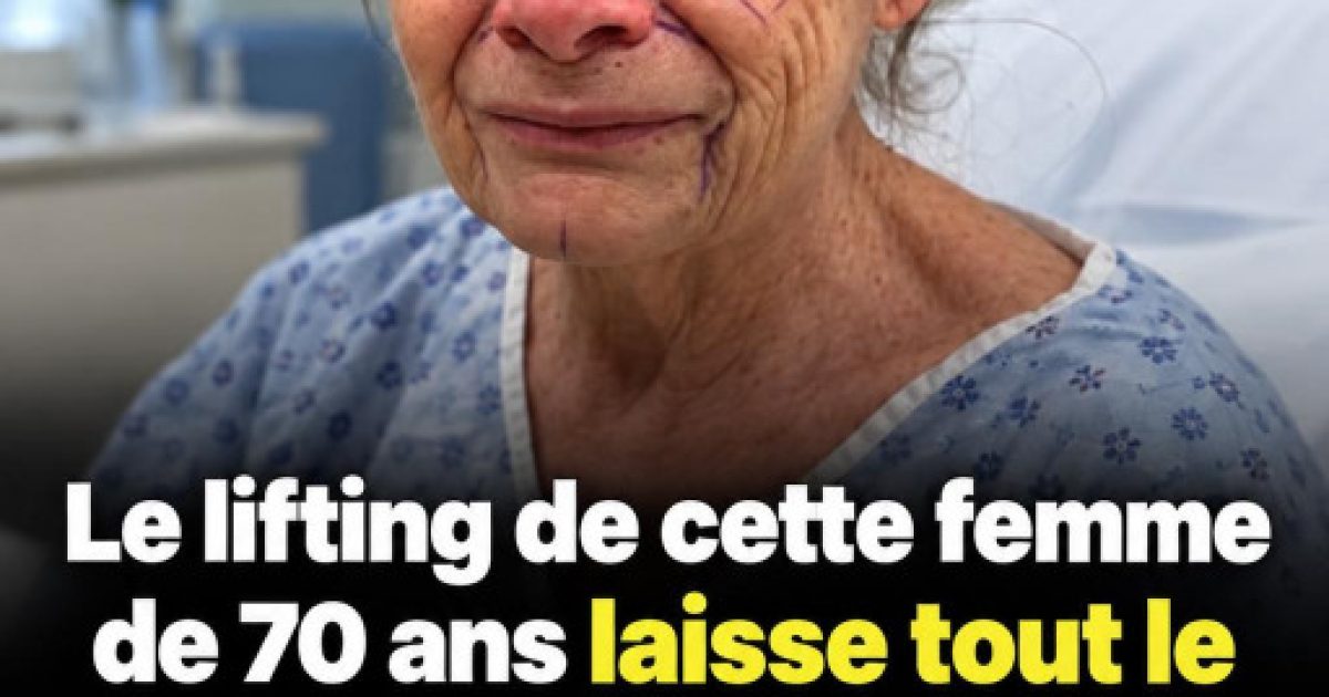 À 70 ans, son lifting fait le tour du web : le chirurgien surnommé "faiseur de miracles"