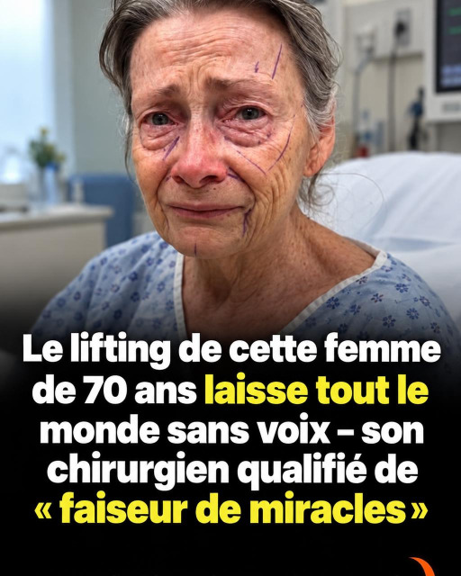 À 70 ans, son lifting fait le tour du web : le chirurgien surnommé "faiseur de miracles"