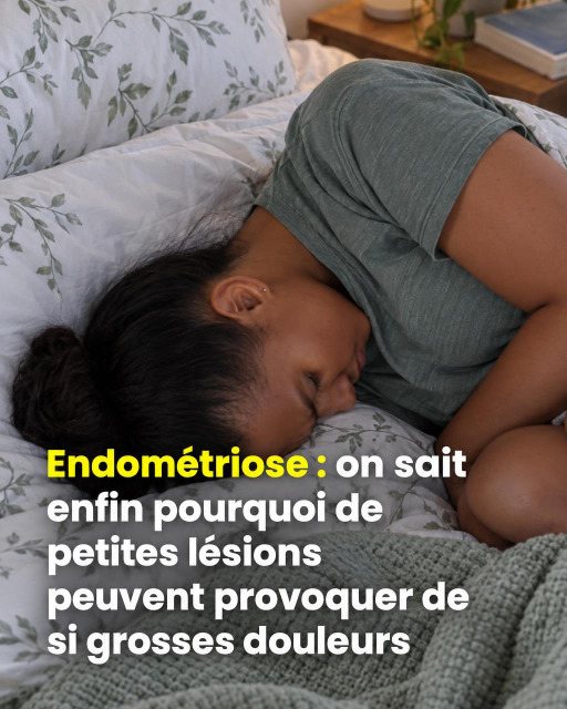 Endométriose : on comprend enfin pourquoi de petites lésions peuvent faire si mal