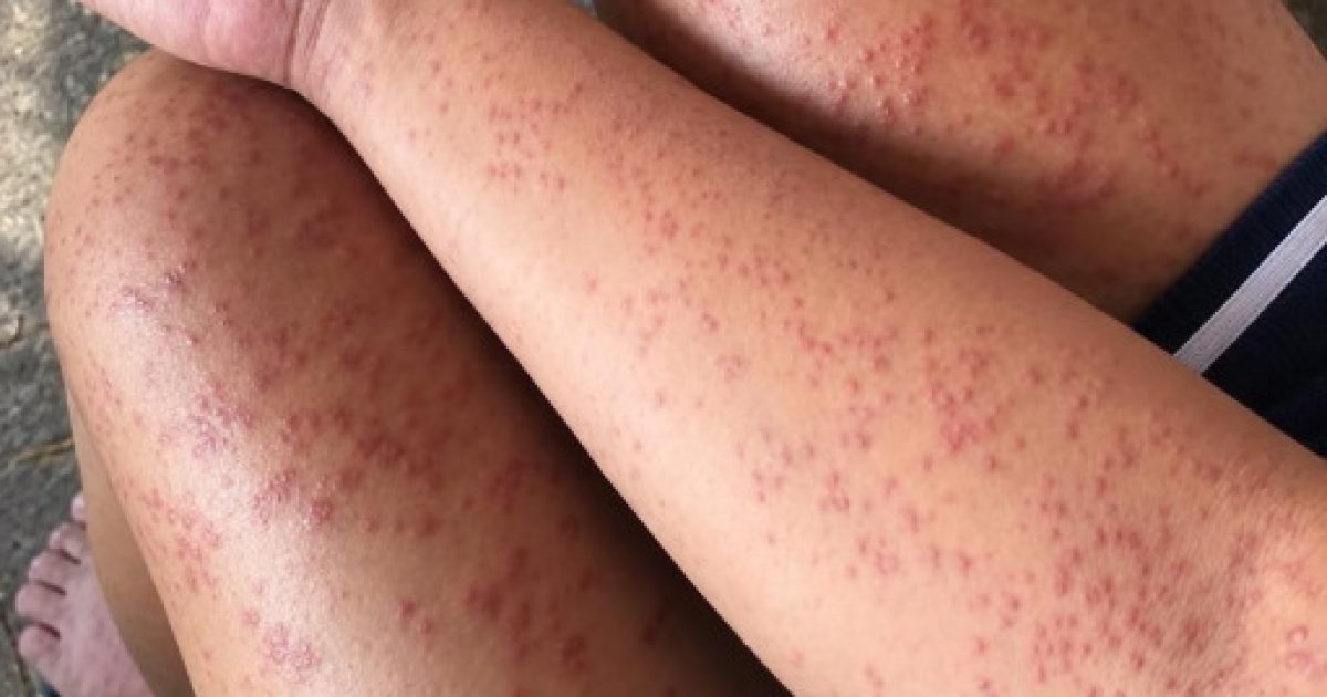 Éruption cutanée et gêne respiratoire : quand votre corps tire la sonnette d'alarme