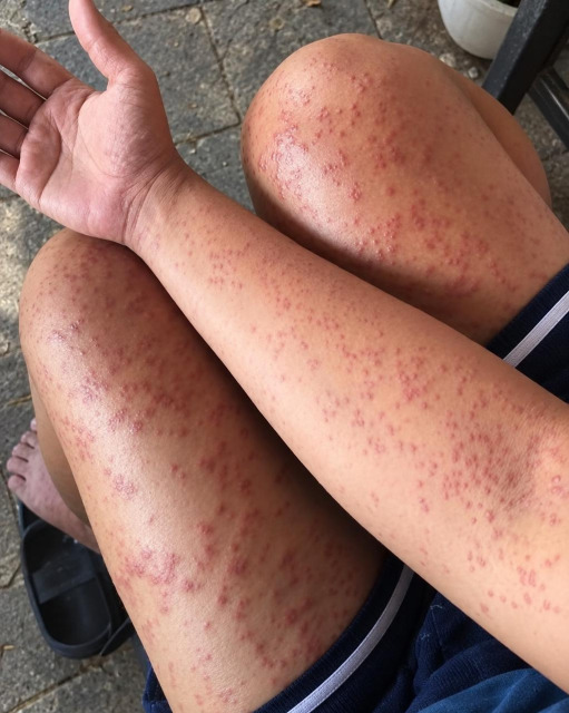 Éruption cutanée et gêne respiratoire : quand votre corps tire la sonnette d'alarme