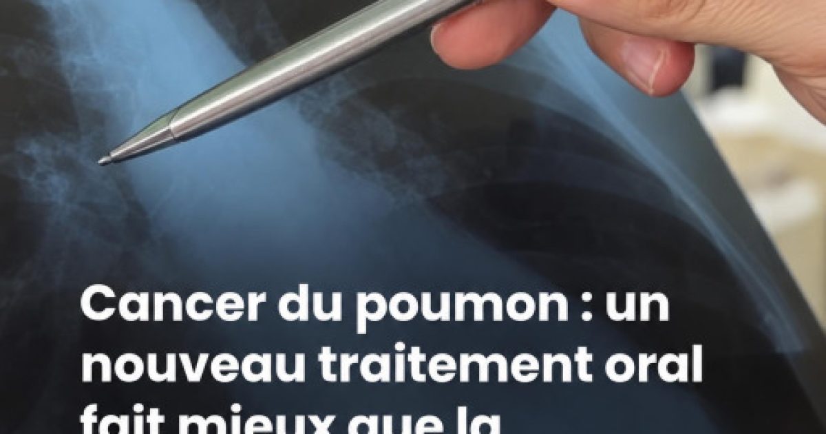 Cancer du poumon : ce nouveau traitement en comprimé montre des résultats impressionnants face à la chimiothérapie
