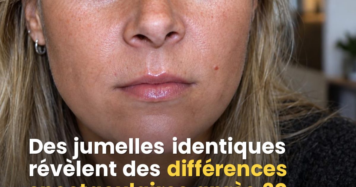 Botox pendant 20 ans vs zéro injection : cette étude sur des jumelles identiques va vous surprendre