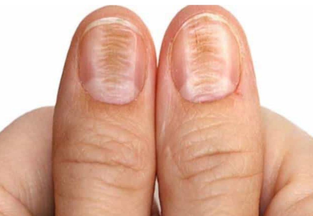 Stries sur les ongles : ce que ces fines lignes révèlent vraiment sur votre santé
