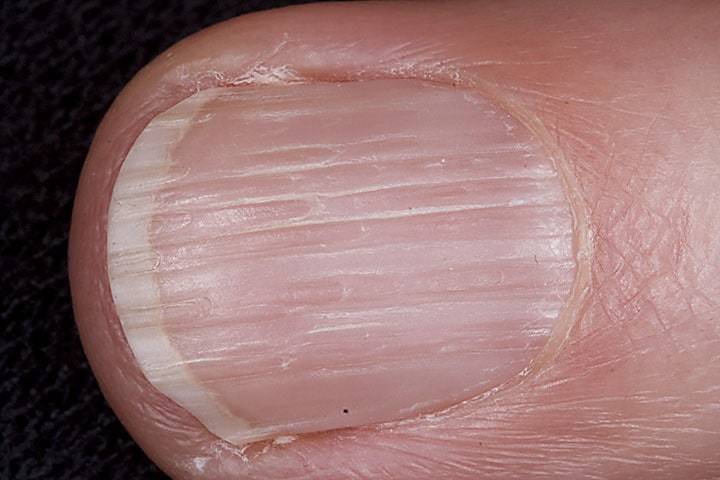 Santé : ces stries sur vos ongles qui en disent long sur votre corps