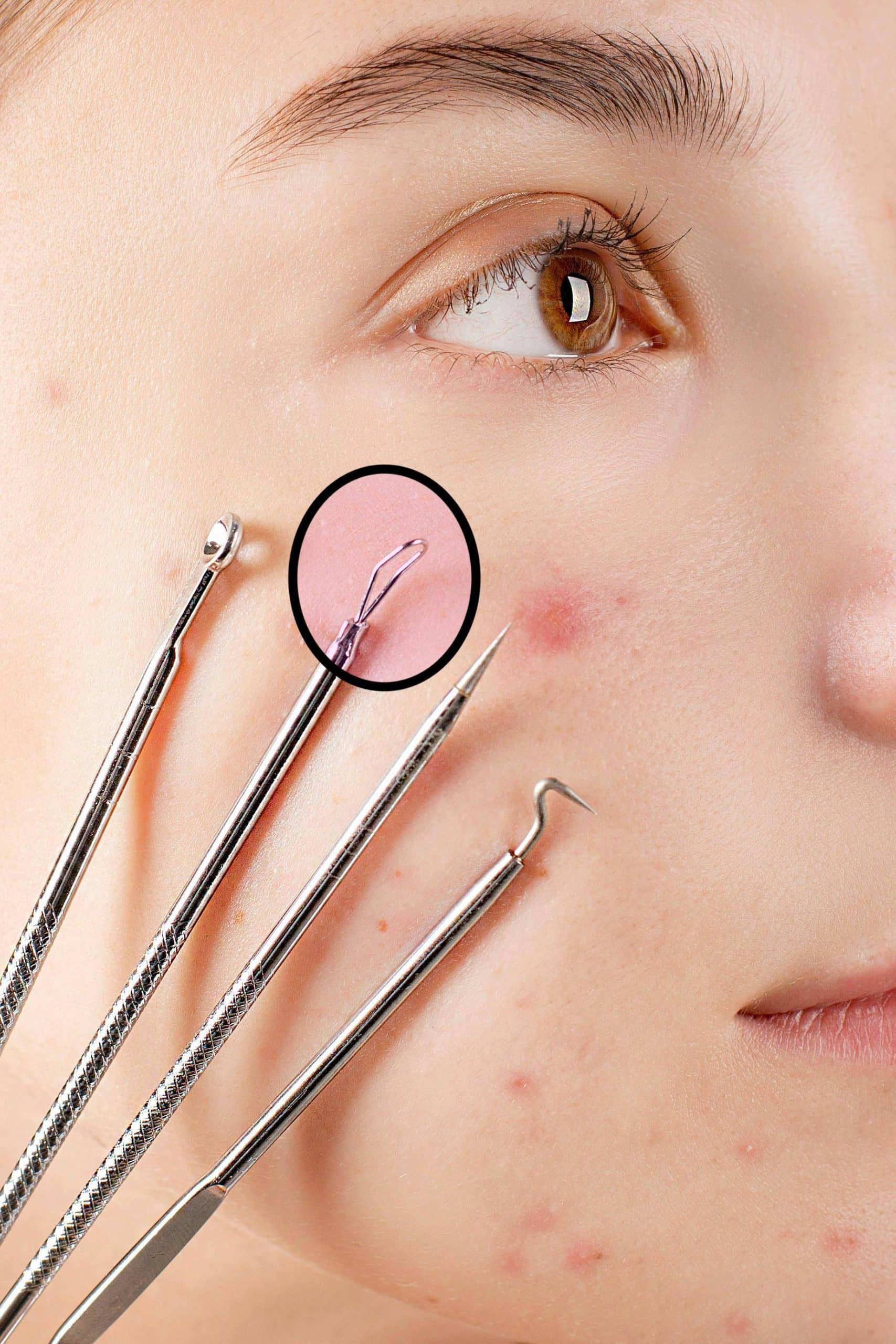 Dermatologue procédant à une extraction